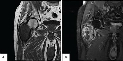 Case report: Treatment of metastatic dedifferentiated chondrosarcoma with pembrolizumab yields sustained complete response